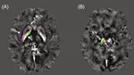 Quantitative evaluation of iron content in idiopathic rapid eye movement sleep behavior disorder